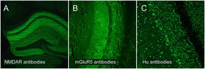 Red Flags: Clinical Signs for Identifying Autoimmune Encephalitis in Psychiatric Patients